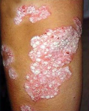 Psoriasis