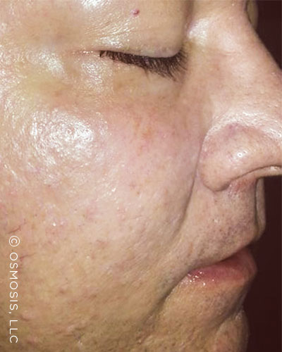 Sebaceous Hyperplasia - After